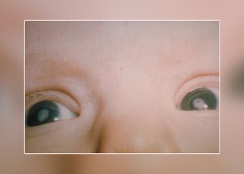 জন্মগত চোখের ছানির চিকিৎসা কি ?