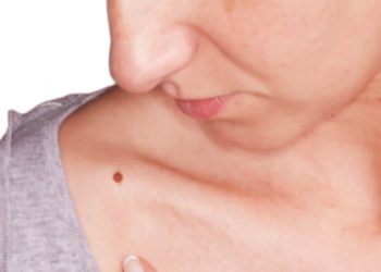 শরীরে তিল